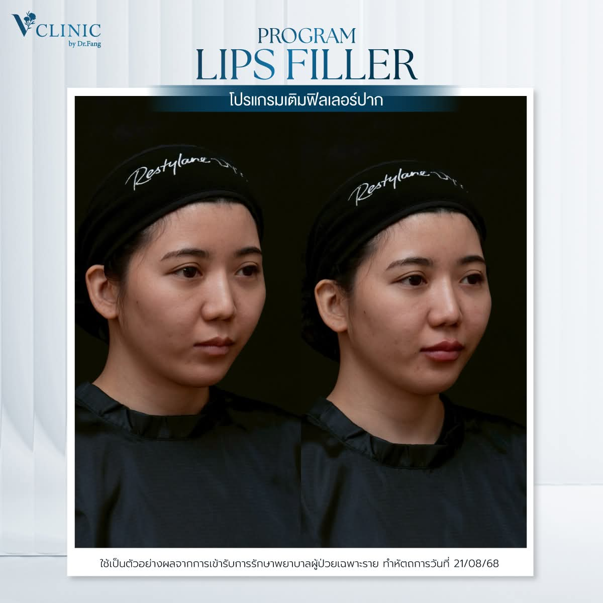 รีวิวฟิลเลอร์ Restylane