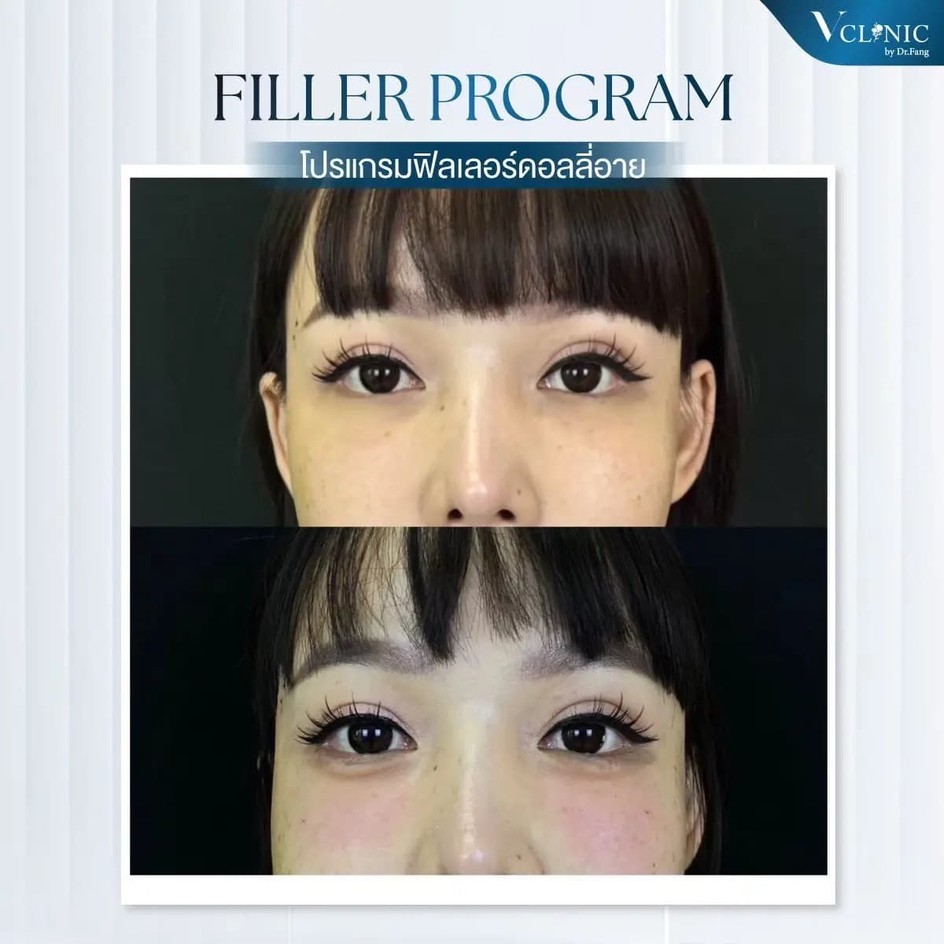 filler-injection-results