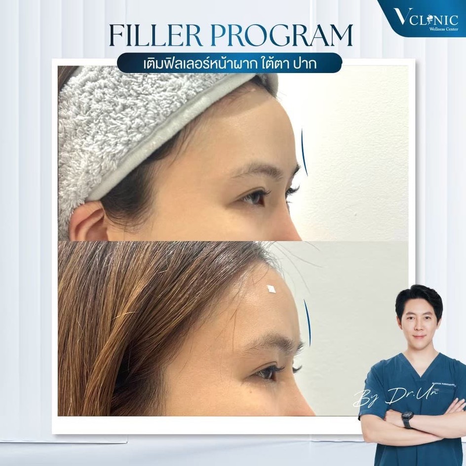 forehead-filler-review