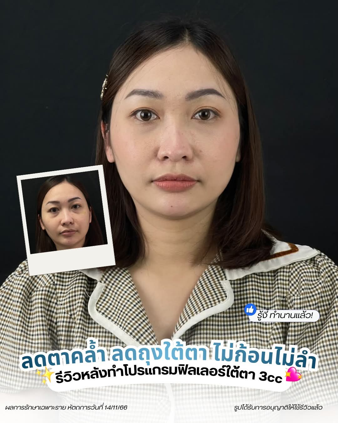 รีวิวหลังฉีดฟิลเลอร์ใต้ตา