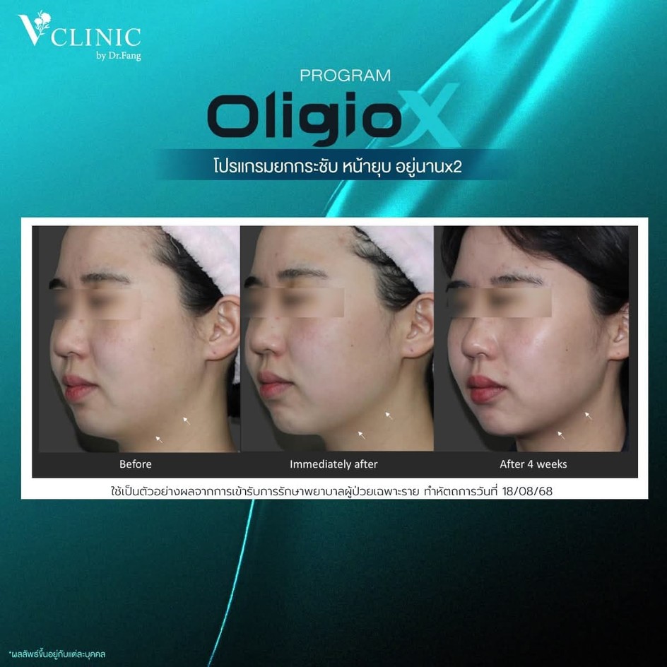 oligio-x-review