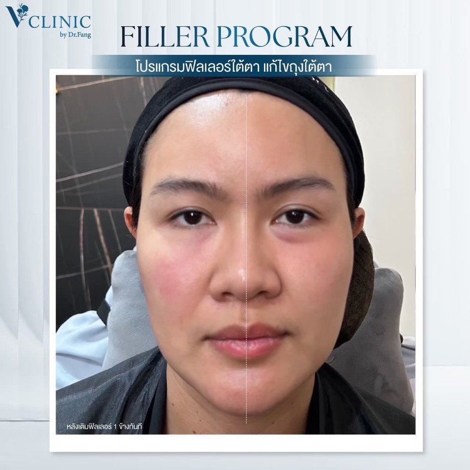 review-filler-under-eye-v-clinic