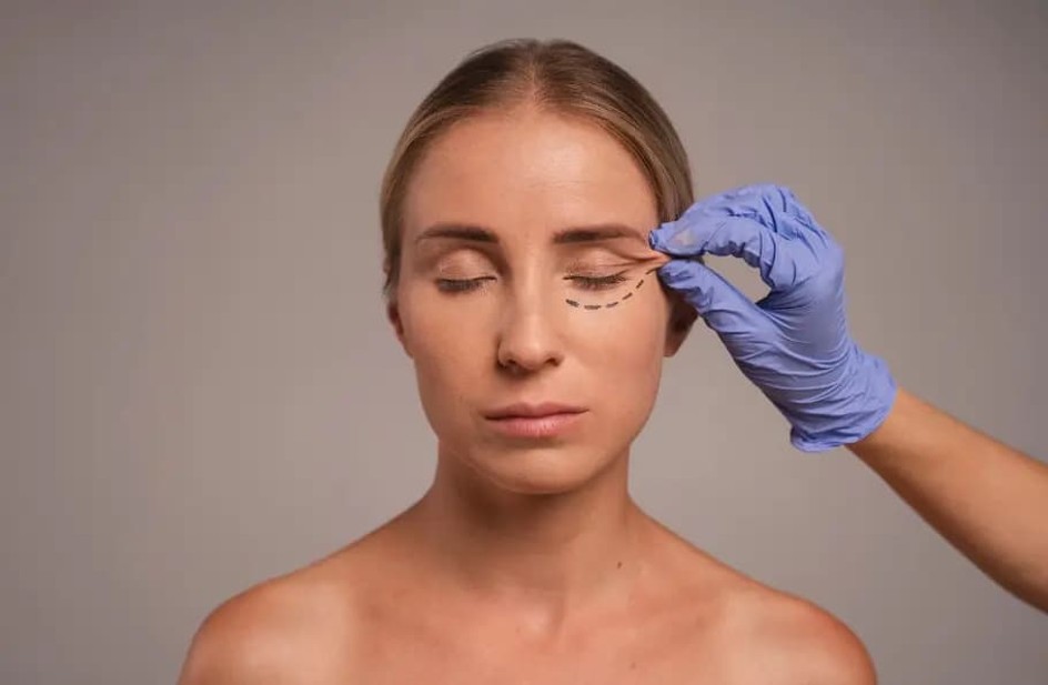 threadlift-definition