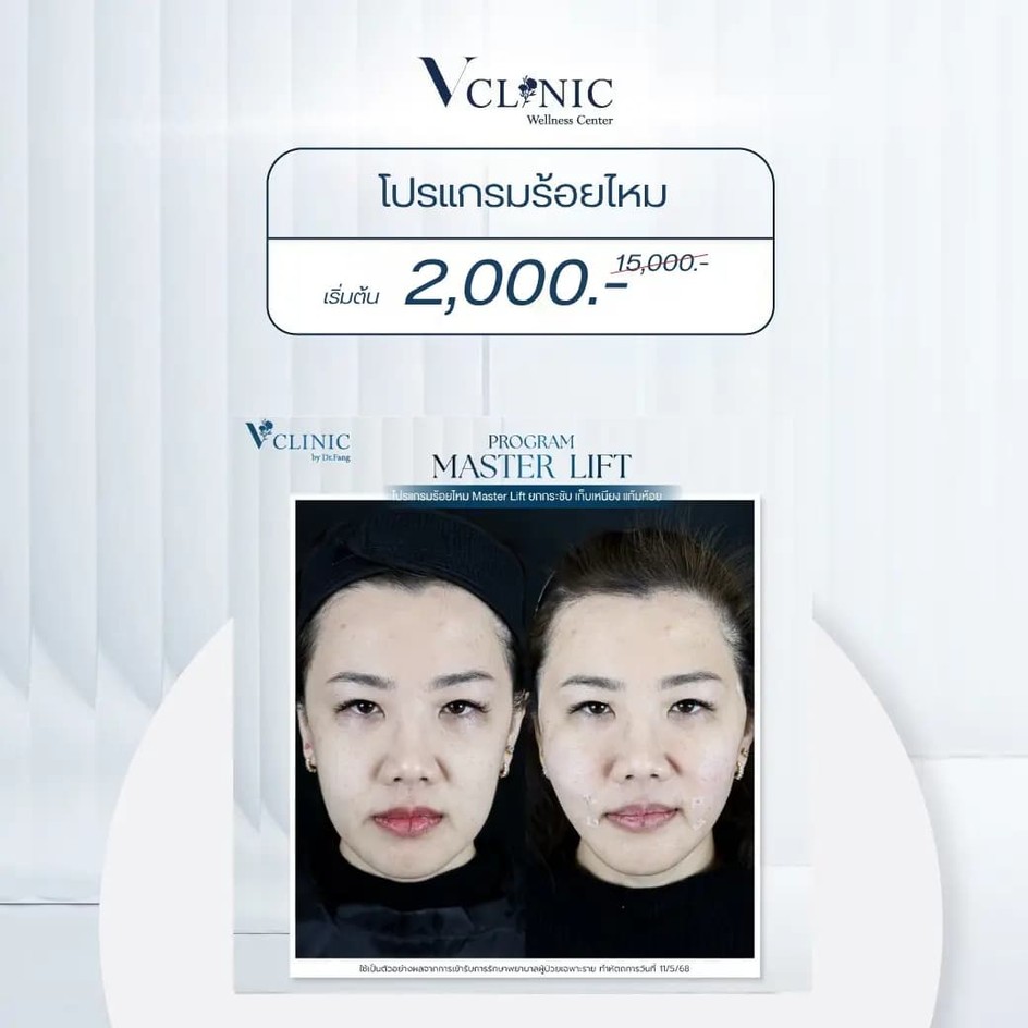 threadlift-review