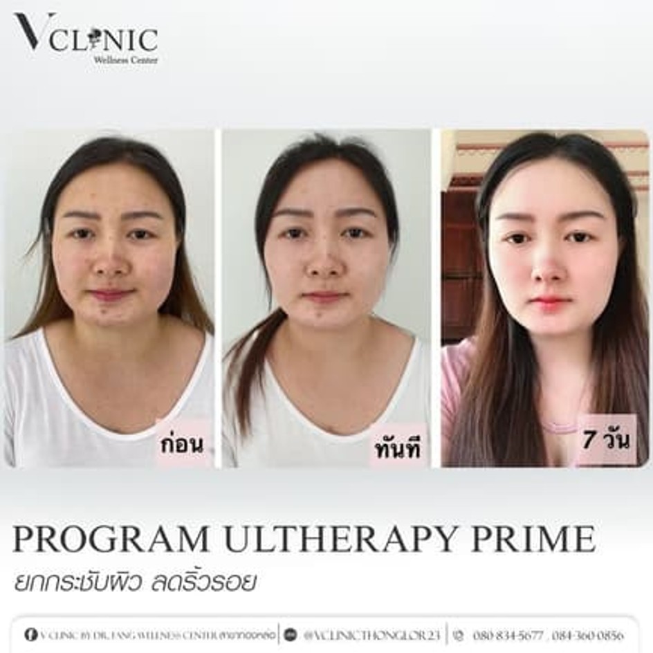 ulthera-prime-review